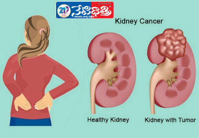 Kidney cancer