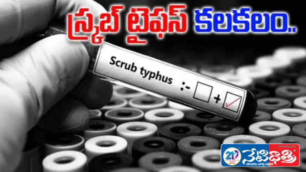 Scrub Typhus Scare in Palnadu