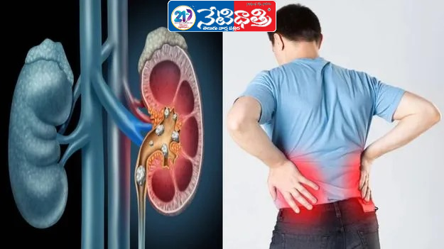 Silent Killer: Kidney Disease Rising in Youth